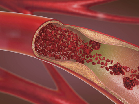 05258 pulmonary embolism1 480